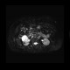 Renal cell carcinoma, RFA, embolization, follow-up: MRI - Magnetic Resonance Imaging